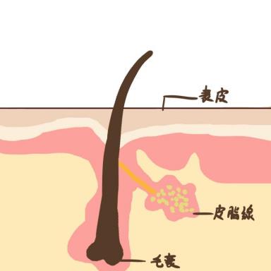 脸上经常长痘痘是什么原因怎么回事？
